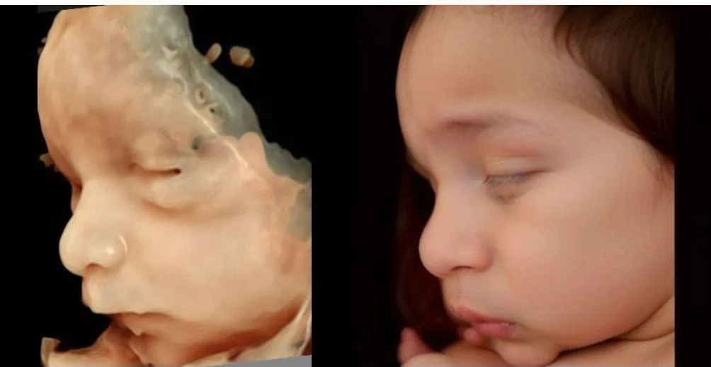 Comparativo 3D + recém-nascido MedFem