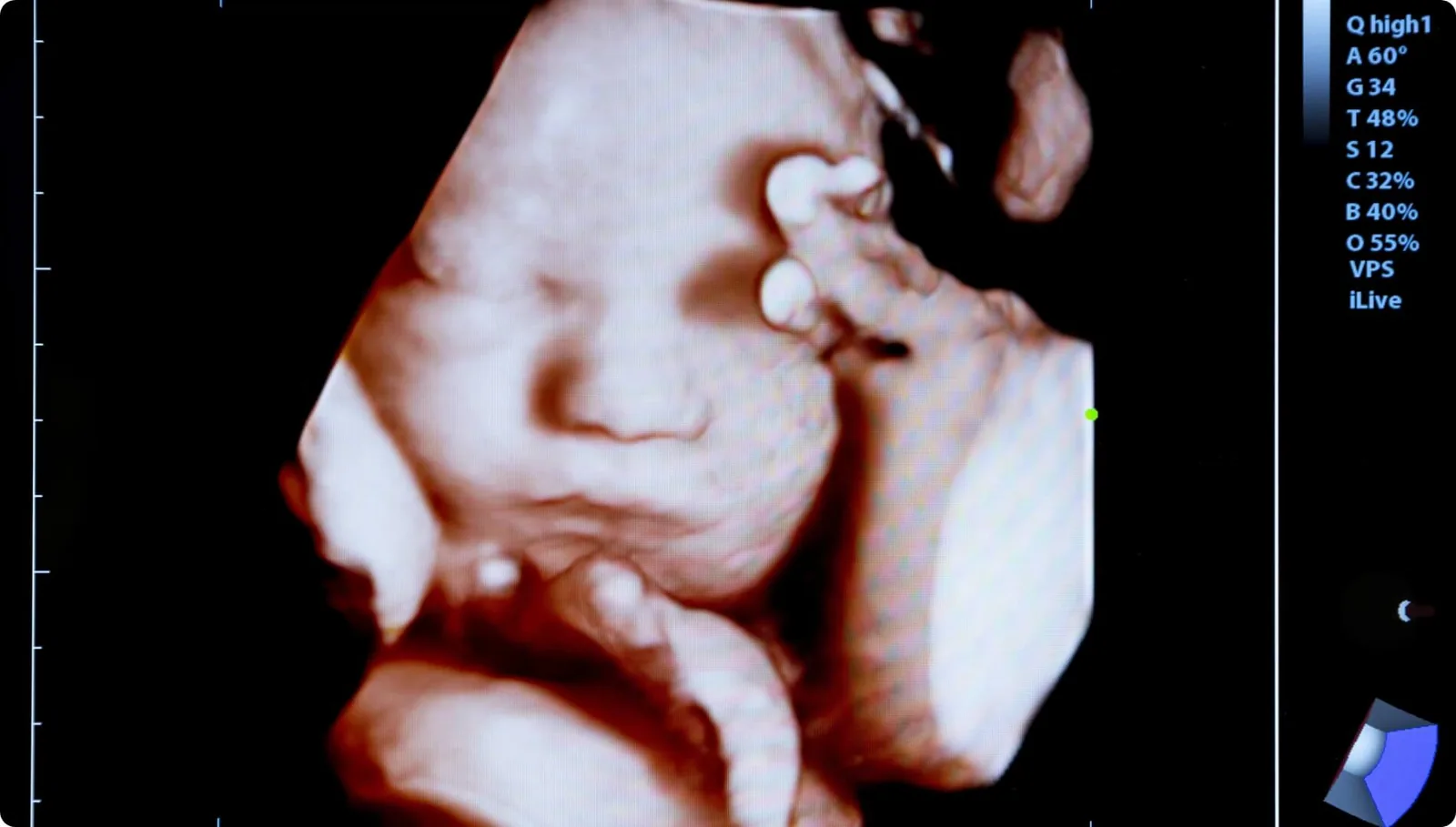 Ultrassonografia 3D MedFem