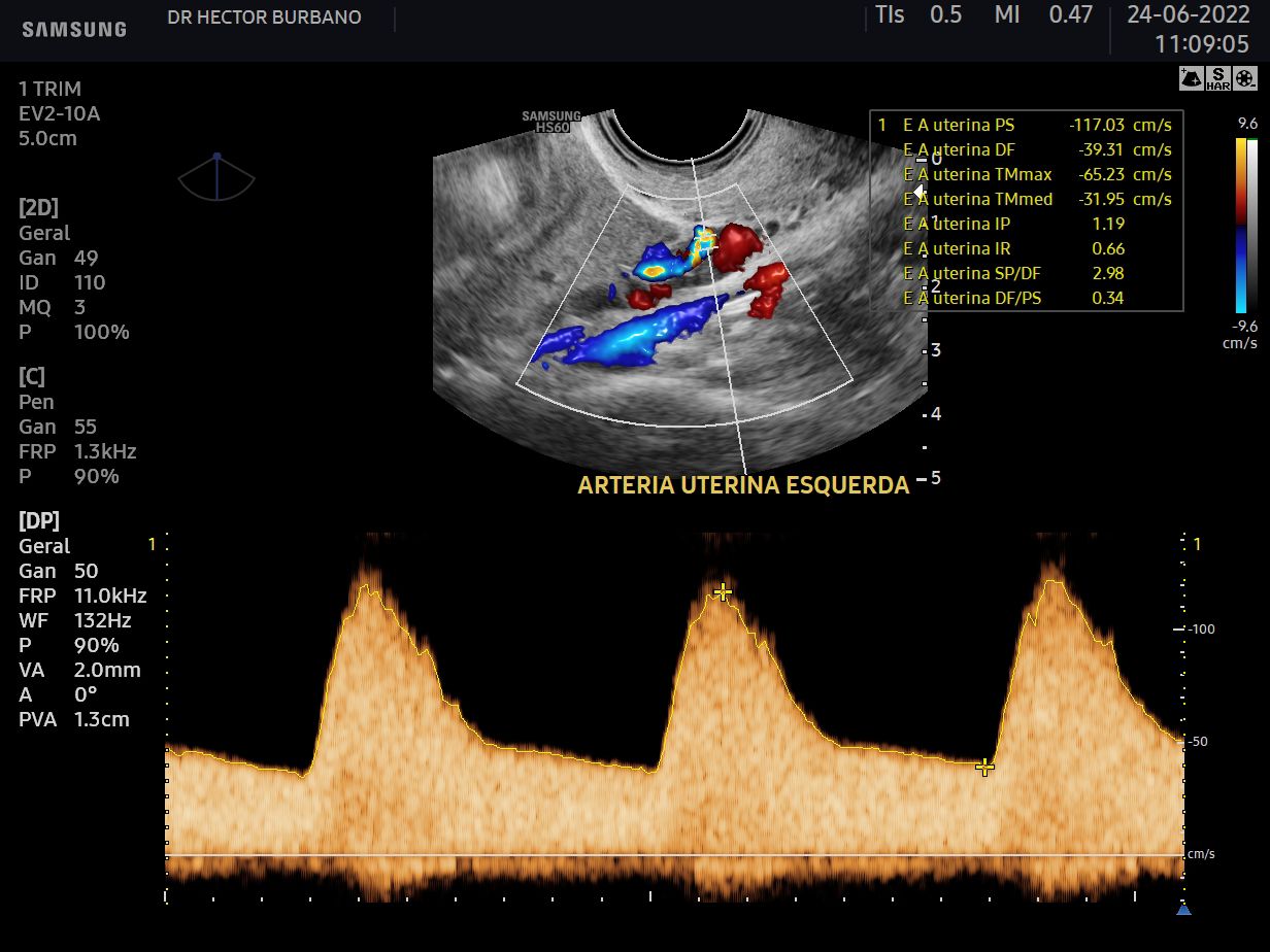 Ultrassonografia Obst Trica Dopplerfluxometria Medfem