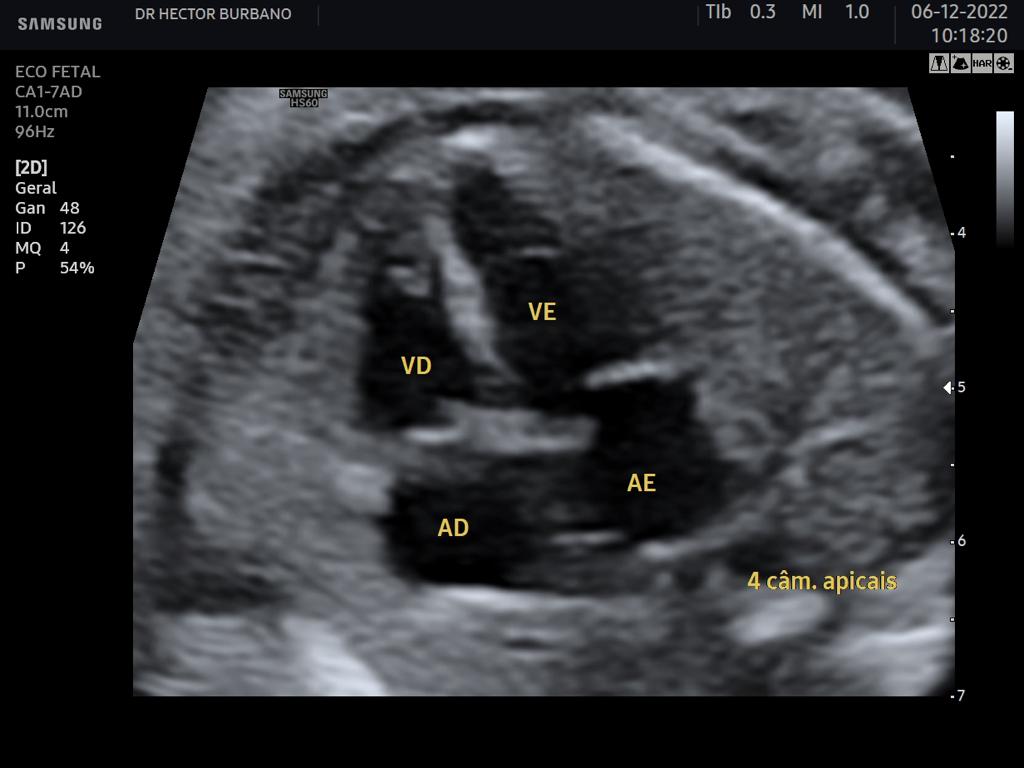 Ecocardiograma Fetal Medfem